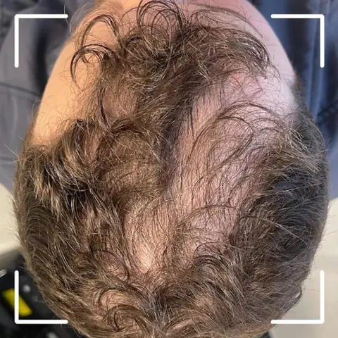 Antes: topo da cabeça com falhas