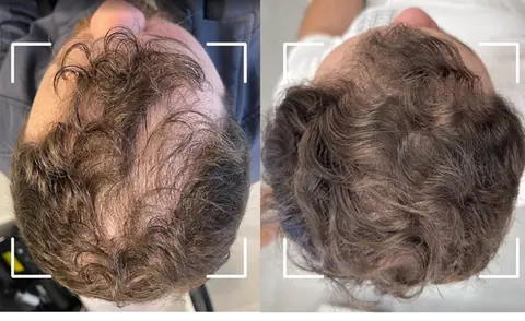 Topo da cabeça de um paciente antes e depois do tratamento capilar