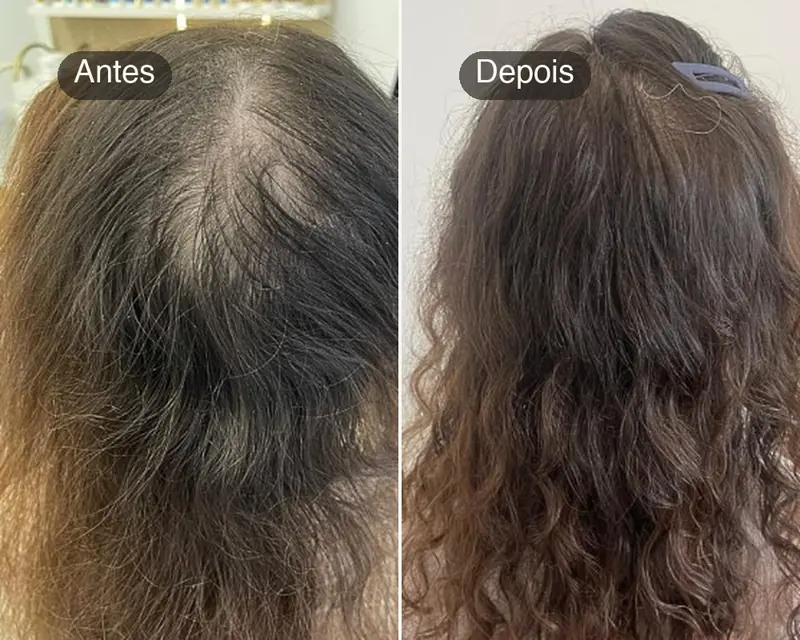 Antes e depois do topo da cabeça de uma paciente com queda de cabelo