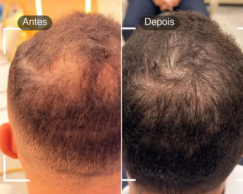 Antes e depois da coroa de um paciente com calvície