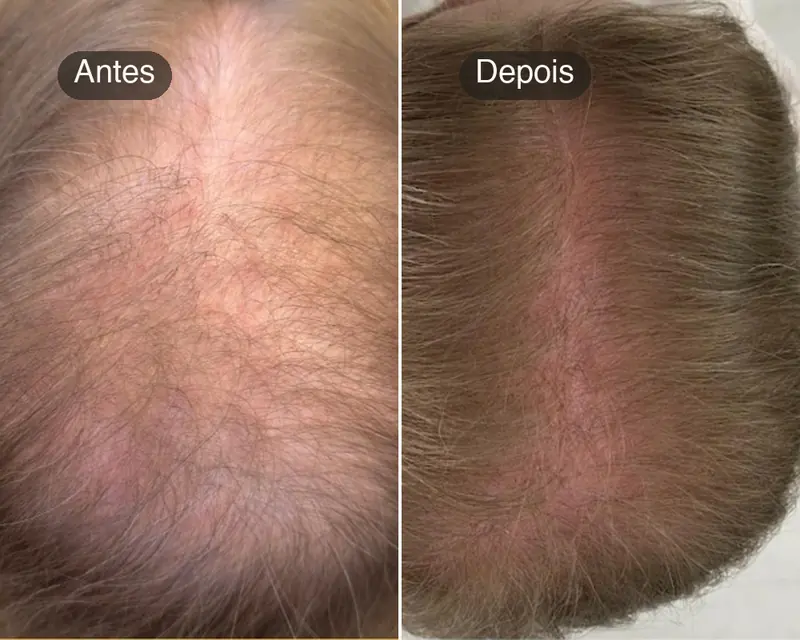 Antes e depois do topo da cabeça, com a risca menos aparente